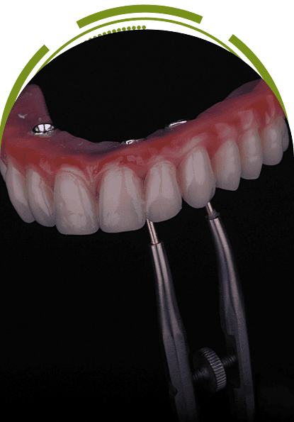 Composite teeth on titanium bar – full arch hybrid prosthesis for All-on-4 implants | EnamelDent All on 4 Tijuana